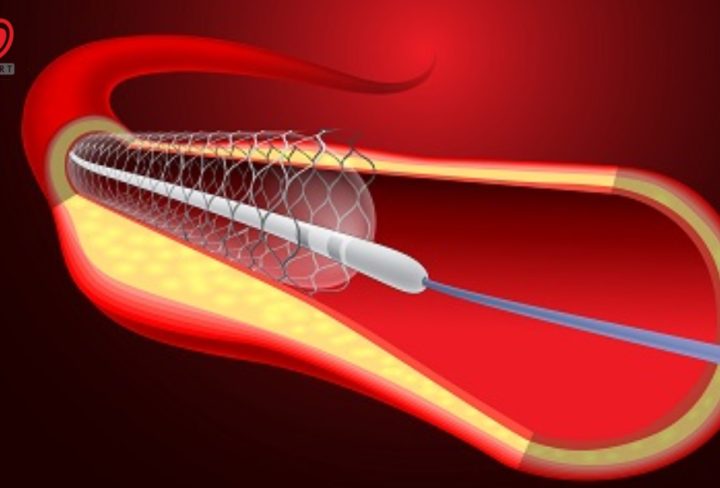 Angioplasty